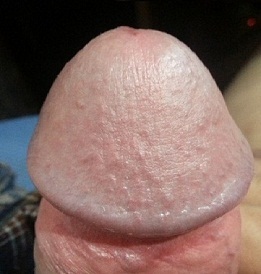 Photo of enlarged glans penis