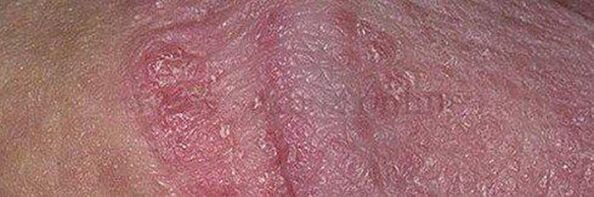 Dry skin and ulcers on the head of the penis after using baking soda