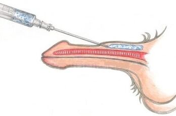 A dangerous method of penis enlargement using vaseline injections